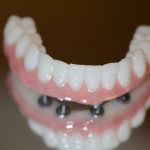 Final Zirconia Bridge