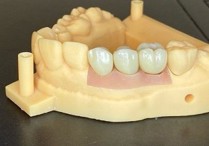 Restorative Bridge